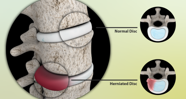 Hernia Pillow